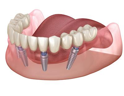 dental implants in doncaster 