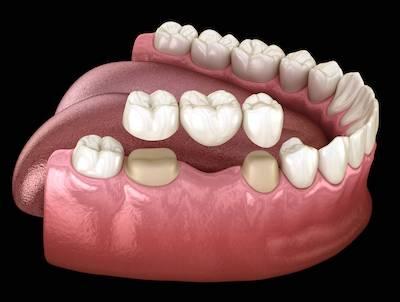 dental bridge in doncaster