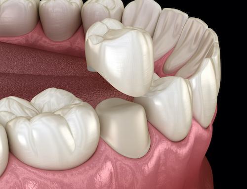 dental crowns in doncaster