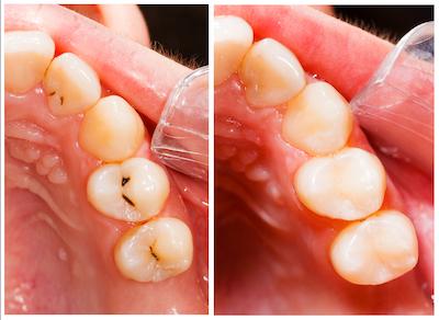 composite fillings in doncaster