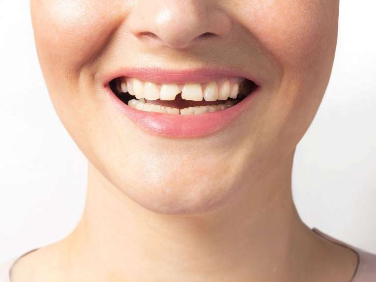 girl with a chipped tooth in doncaster