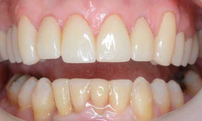 After treatment - Clear Aligners and Crowns/Veneers 