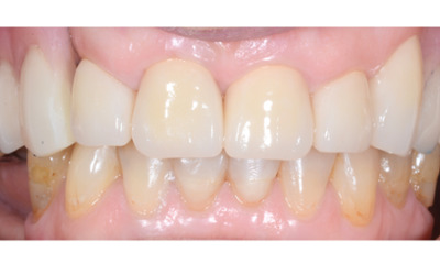 After treatment - Dentures, Crowns and Bite Reconstruction