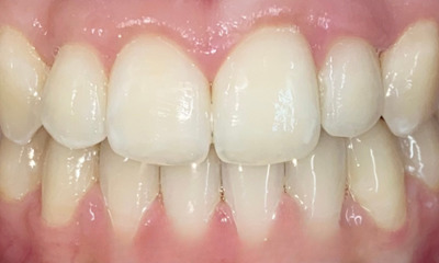 After treatment - Fixed Braces