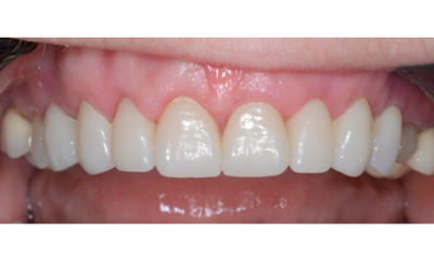 After treatment - Gum Lift, Crown and Veneers 