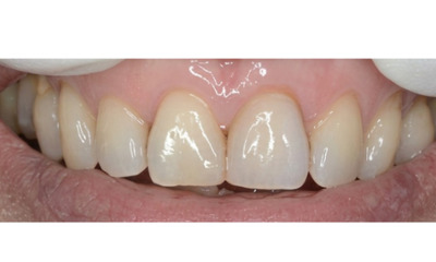 After treatment - Single Crown Colour Matching