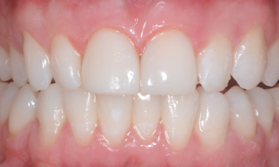 After treatment - Teeth Whitening and Composite Fillings