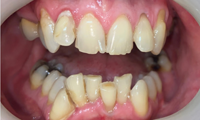 Before treatment - Clear Aligners and Crowns/Veneers 