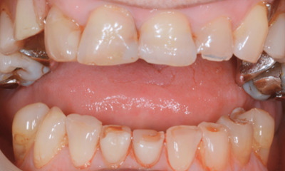 Before treatment - Dentures, Crowns and Bite Reconstruction