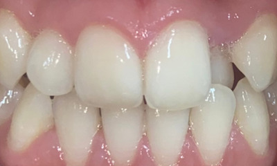 Before treatment - Fixed Braces