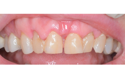 Before treatment - Gum Lift, Crown and Veneers 
