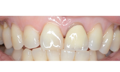 Before treatment - Single Crown Colour Matching