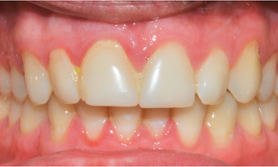 Before treatment - Teeth Whitening and Composite Fillings